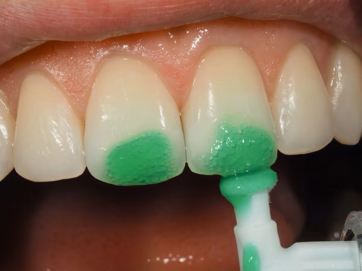 A close up of a person's teeth with green gel.