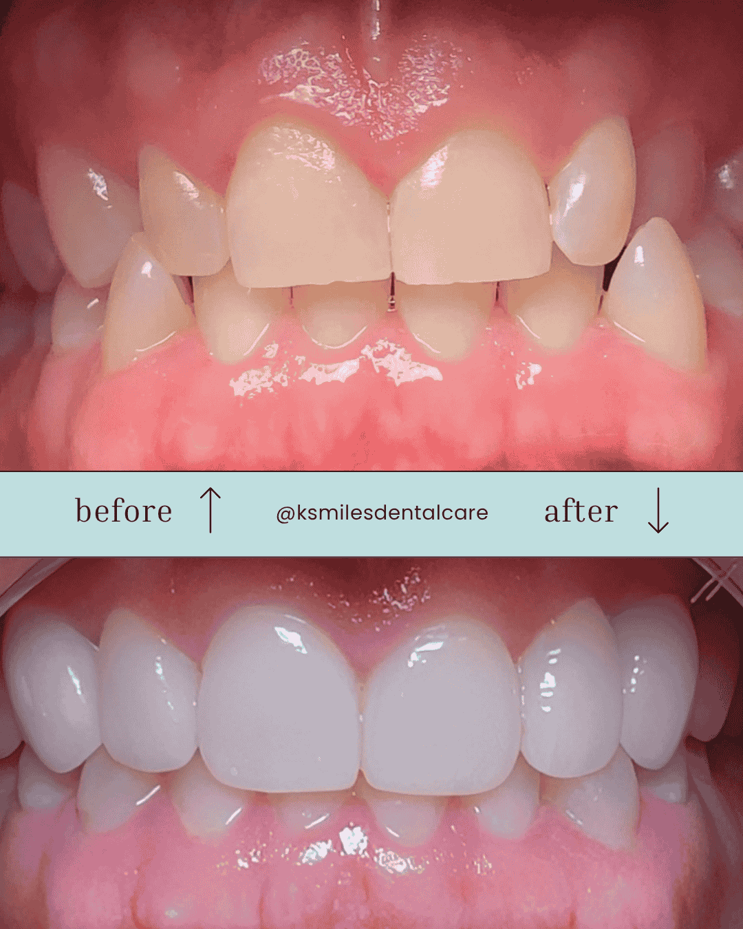 Veneers & Smile Makeovers in Oshawa: What to Expect, Cost, and Results
