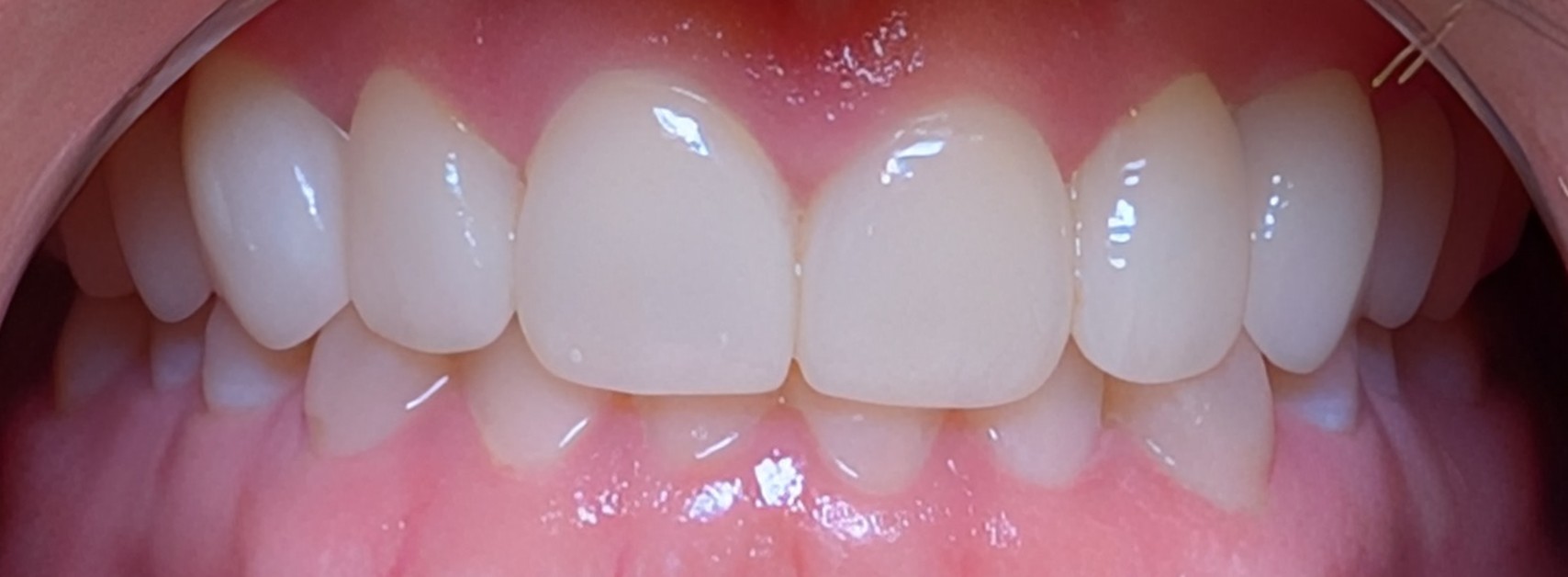 Veneers & Smile Makeovers in Oshawa: What to Expect, Cost, and Results