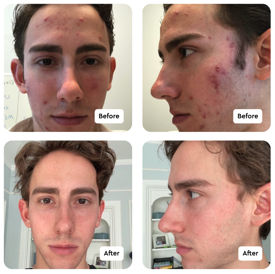Clear Your Skin With Honeydew Care Online On Your Schedule Honeydew