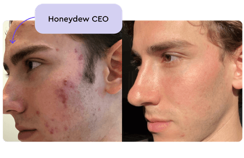 Clear Your Skin With Honeydew Care Online On Your Schedule Honeydew