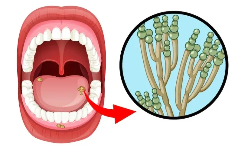Tratamiento Hongos En La Lengua C mo Curar La Candidiasis Bucal 6 Tratamiento Hongos En La Lengua C mo Curar La Candidiasis Bucal 6