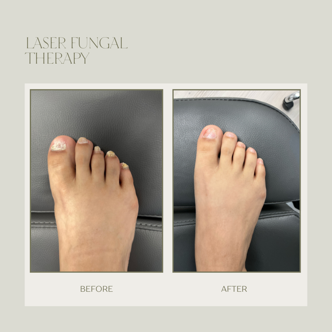 fungal toenail laser therapy before and after