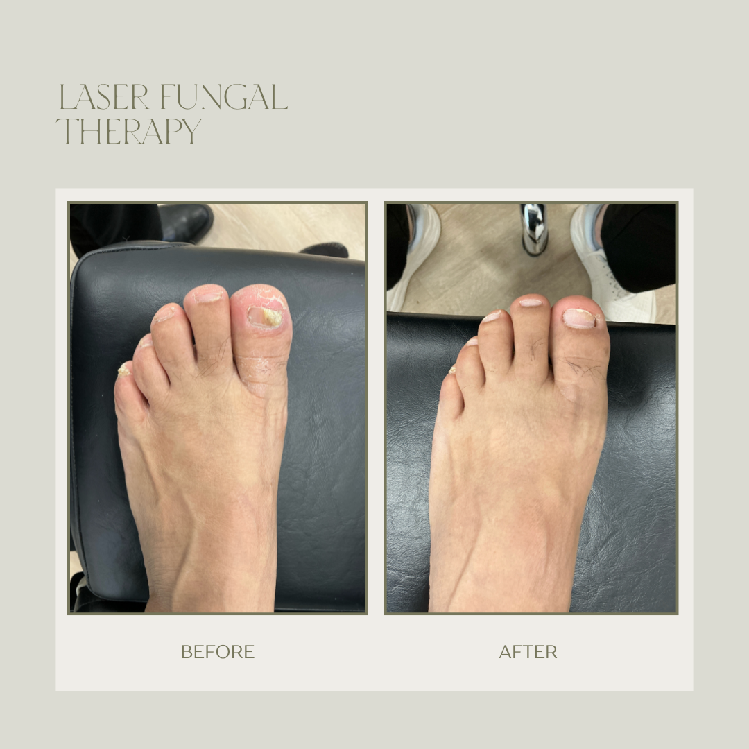 fungal toenail laser therapy before and after