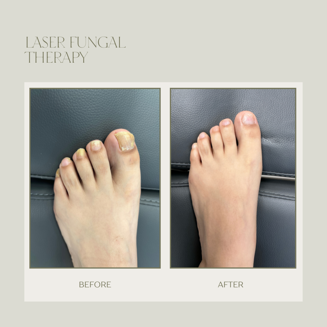 fungal toenail laser therapy before and after