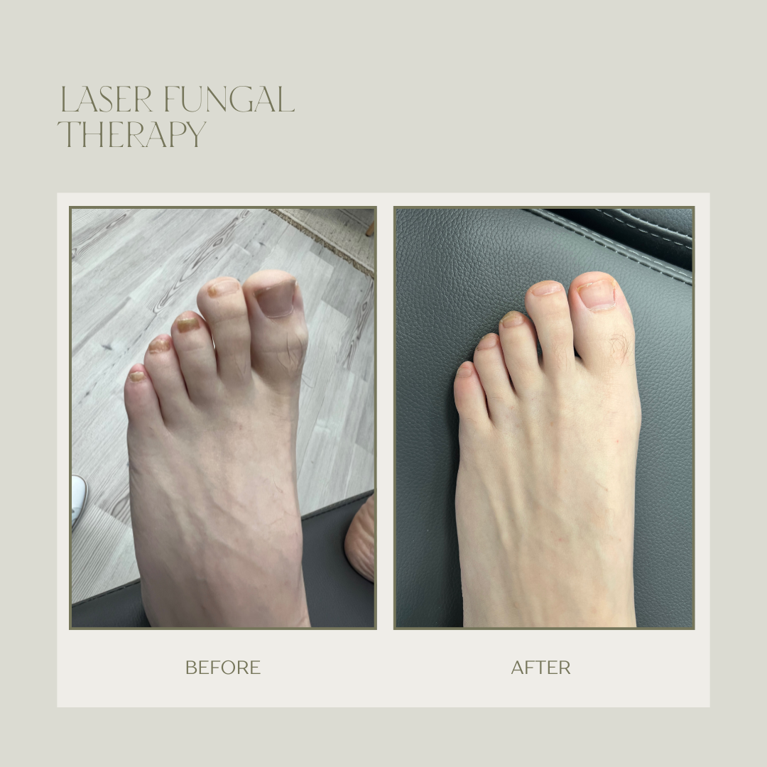 fungal toenail laser therapy before and after