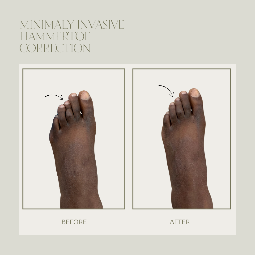 Before and after minimally invasive hammertoe surgery result 2