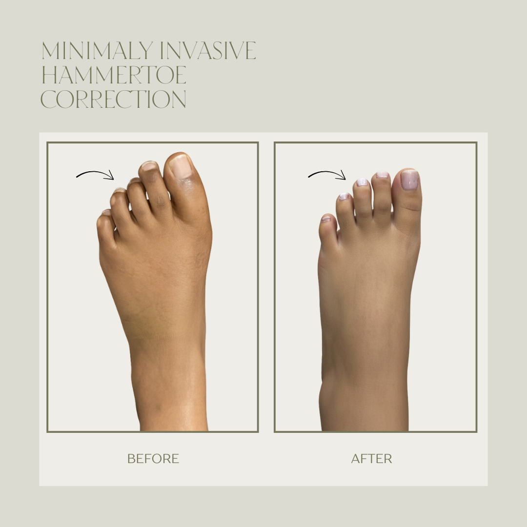 Before and after minimally invasive hammertoe surgery result 4