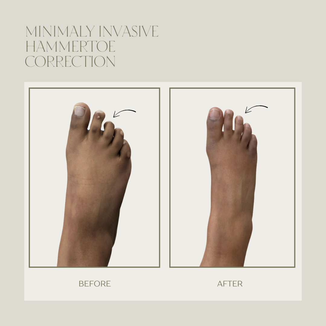 Before and after minimally invasive hammertoe surgery result 5