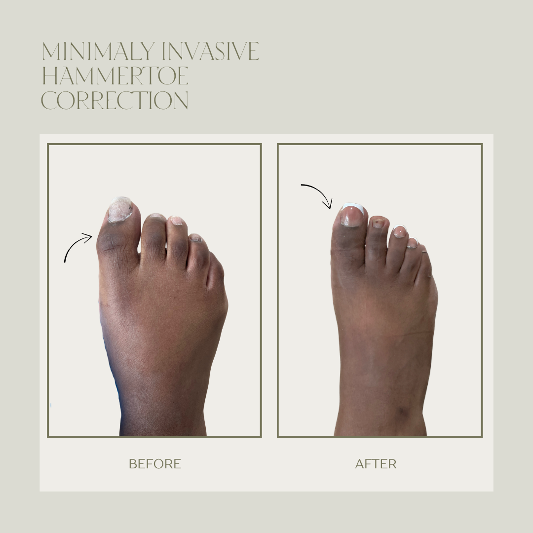 Before and after minimally invasive hammertoe surgery result 1