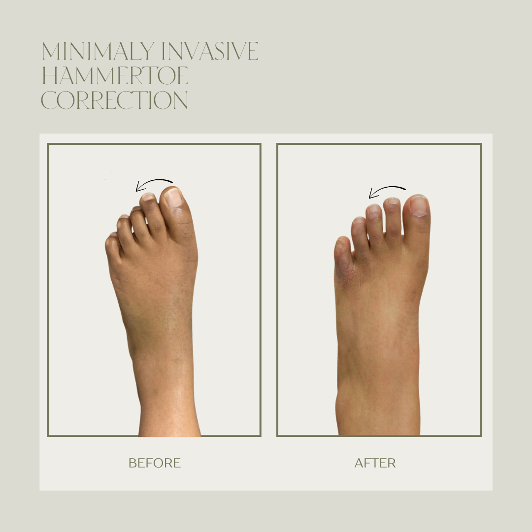 Before and after minimally invasive hammertoe surgery result 3