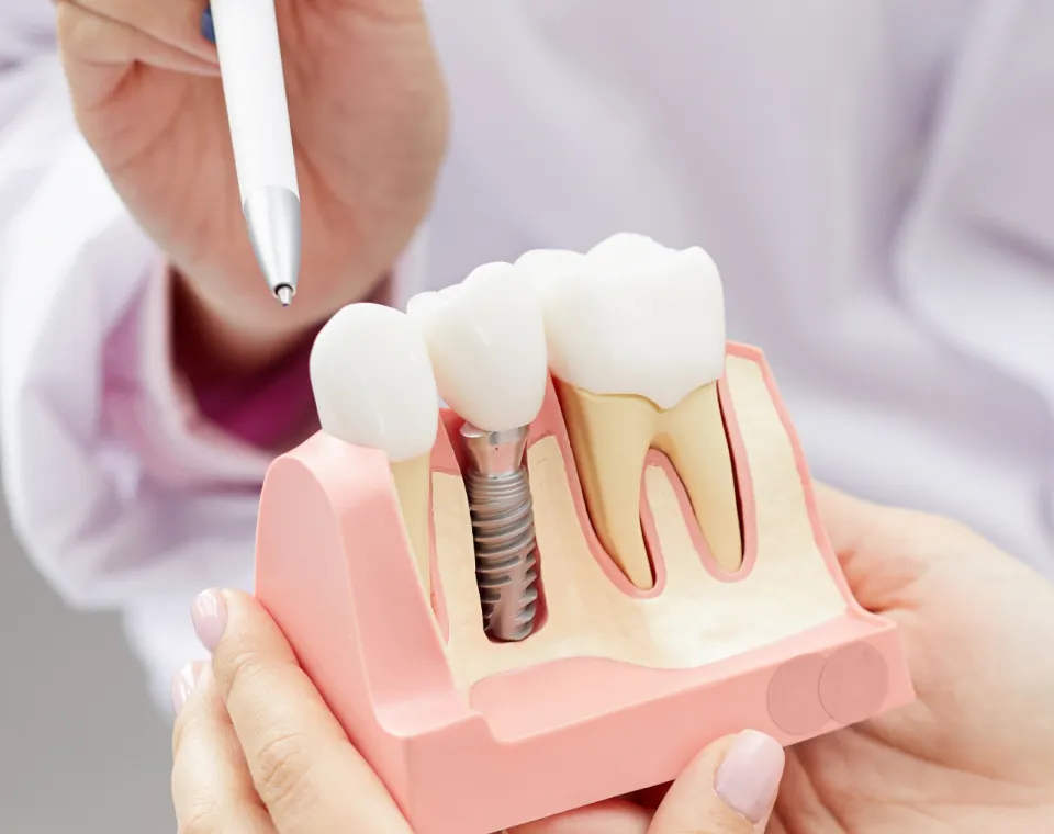 How to Maintain Your Dental Implants in Frisco, TX