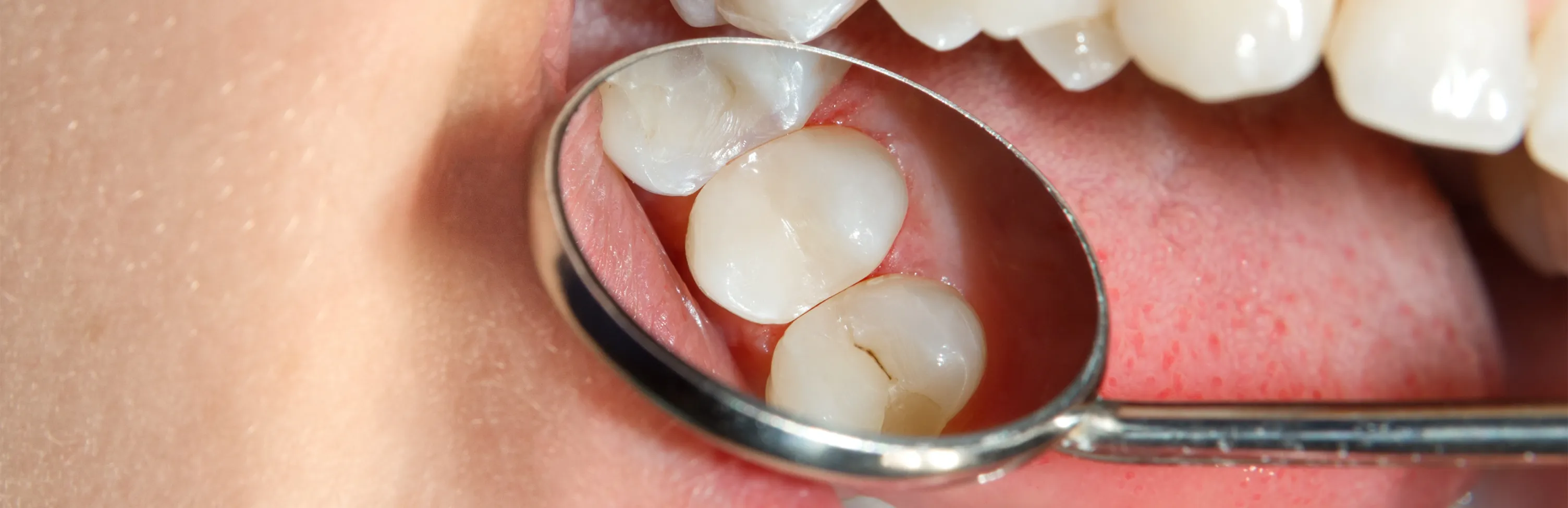 The Benefits of Dental Sealants for Children in Frisco, TX