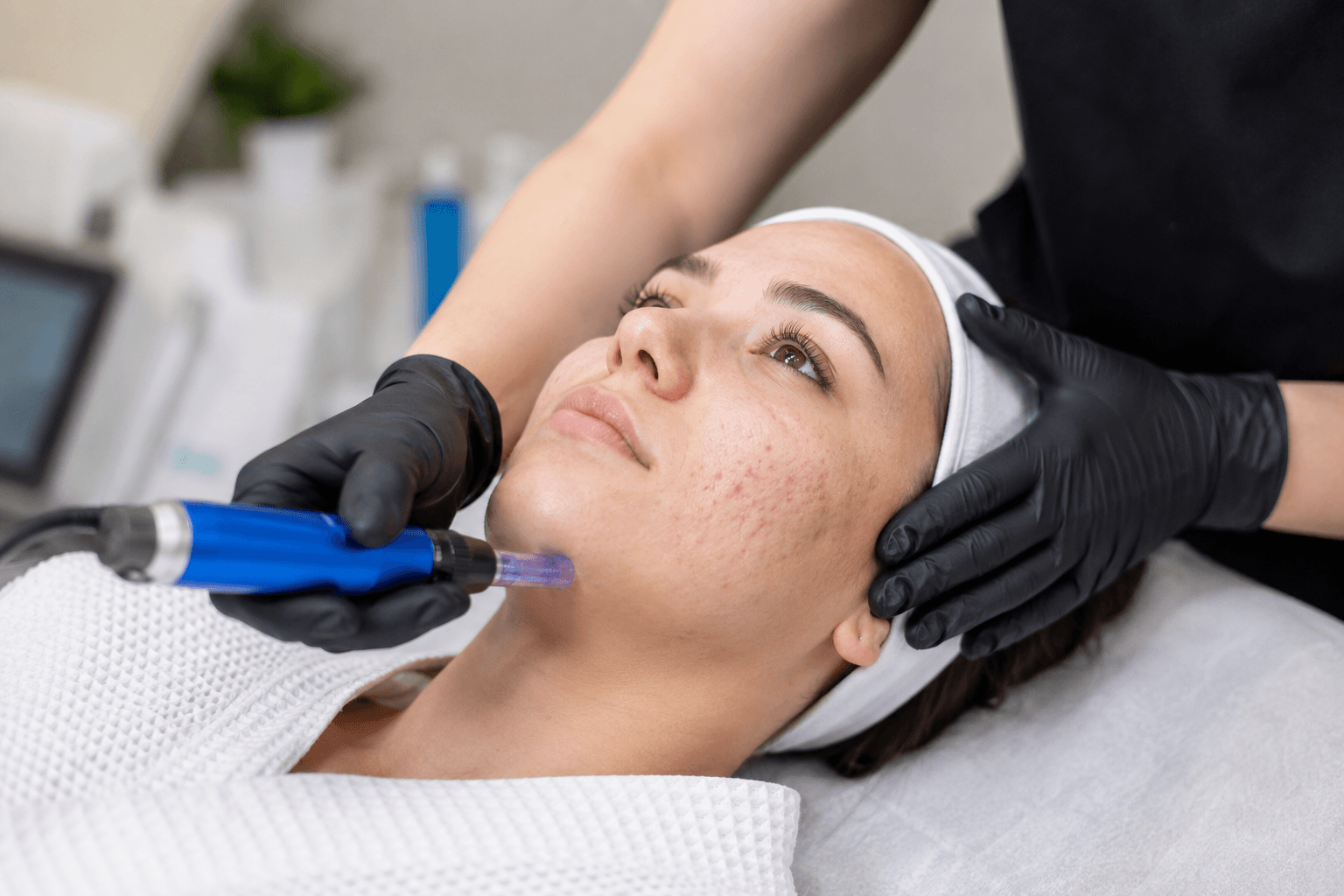 Microneedling treatment for acne scars in McMurray, Pennsylvania using SkinPen device to improve skin texture and stimulate collagen.