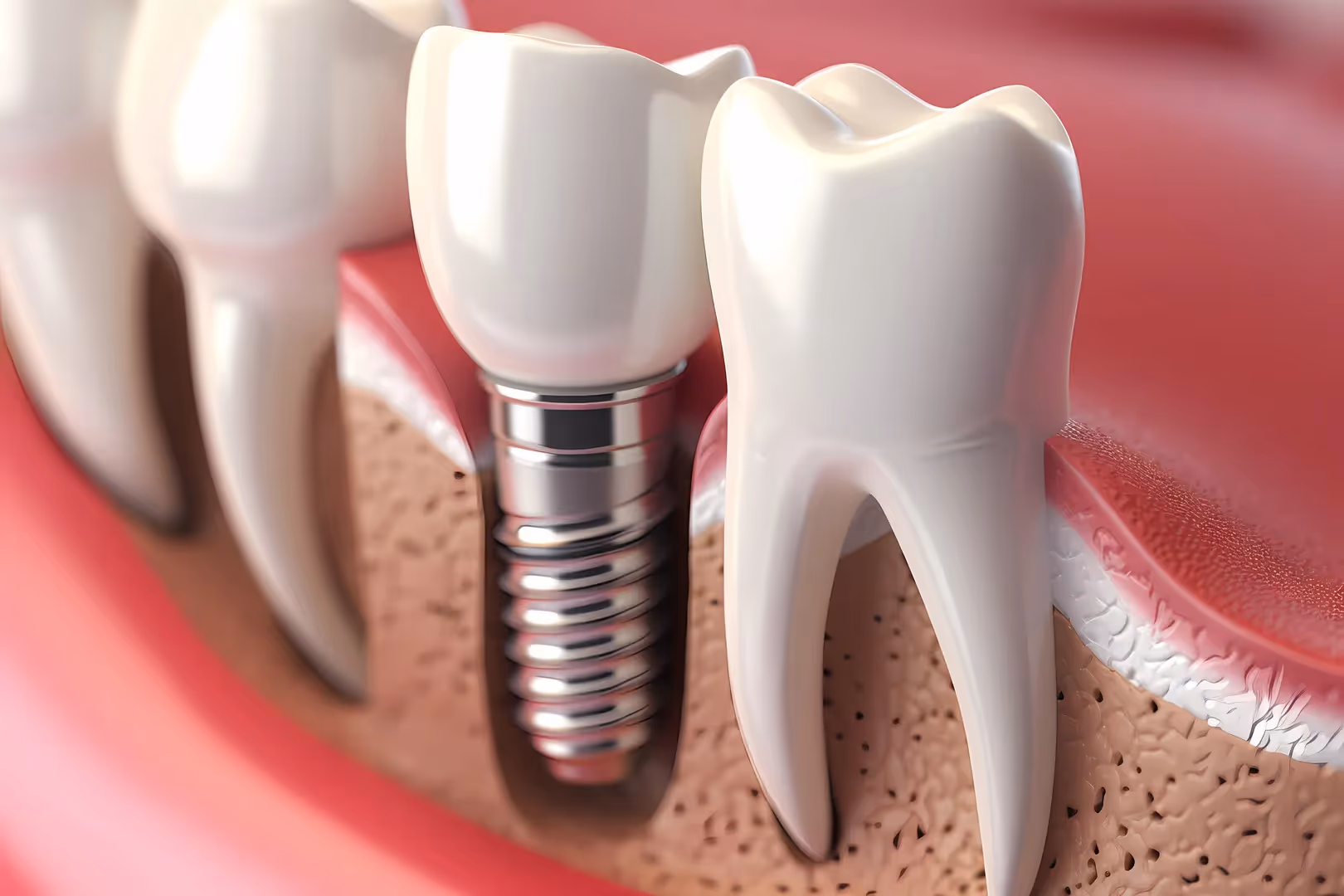 Single Tooth Implants
