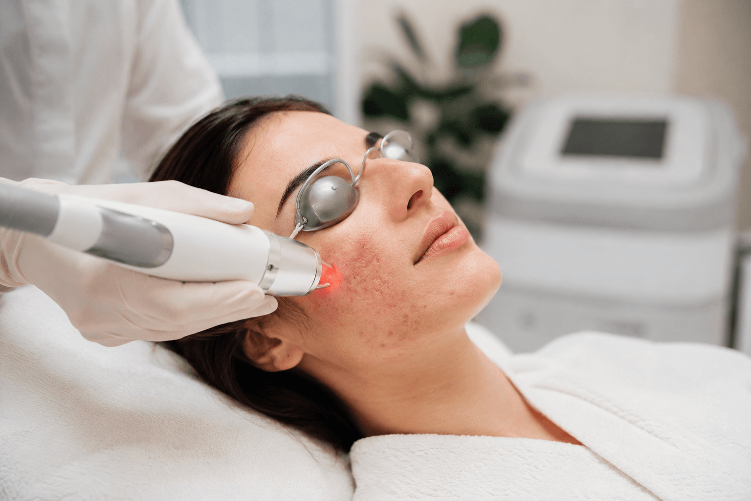 Patient receiving Laser Treatments for acne scar improvement at Dermatology Associates of Georgia in Monroe, Georgia
