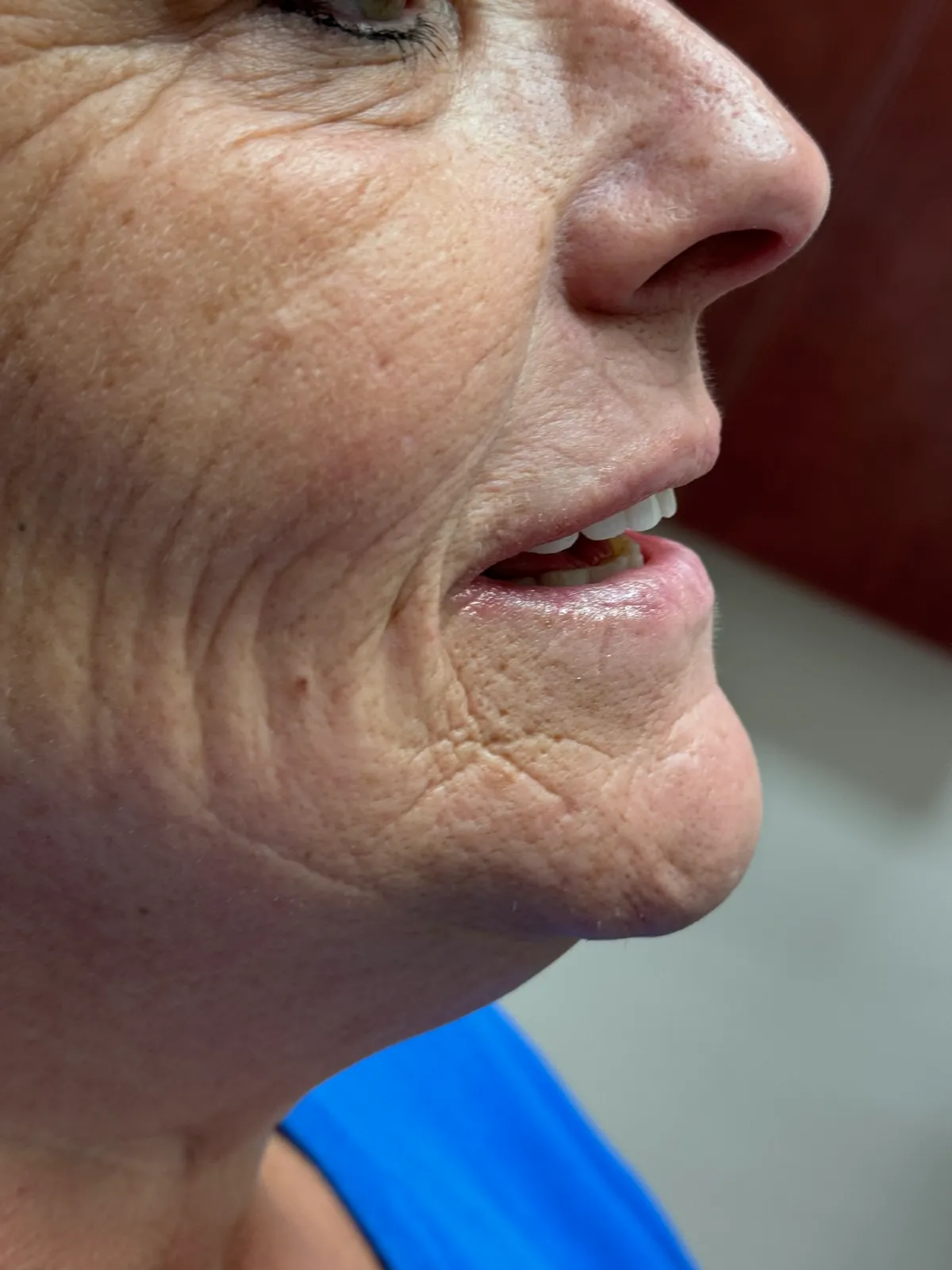 Smile Makeover After Treatment