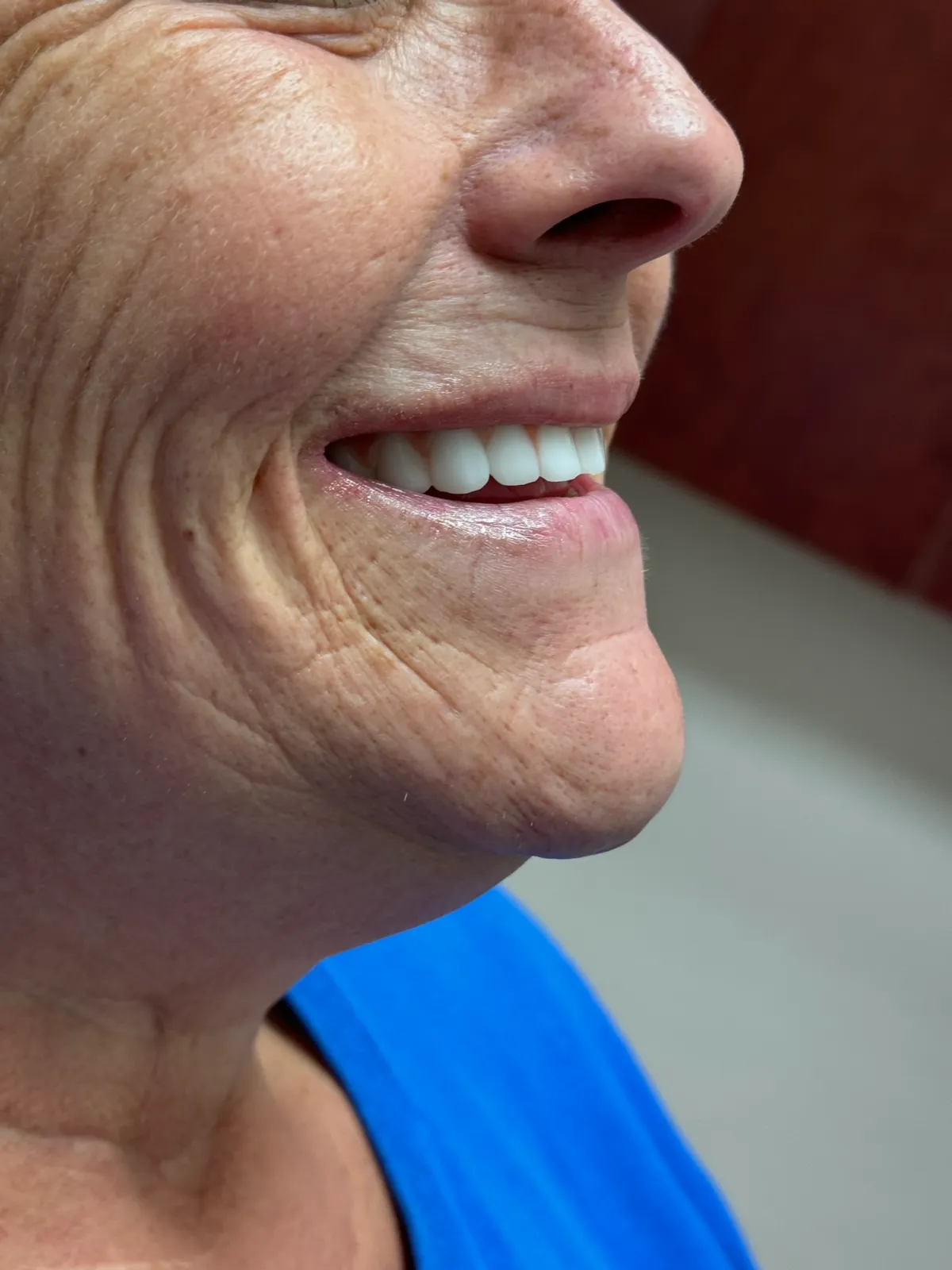 Smile Makeover After Treatment