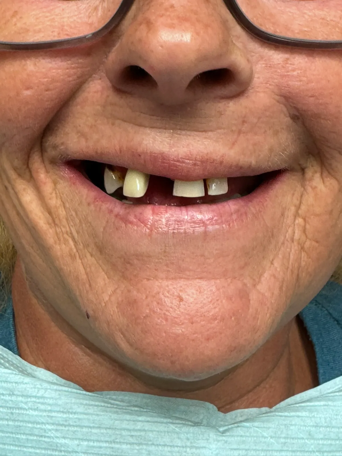 Smile Makeover Before