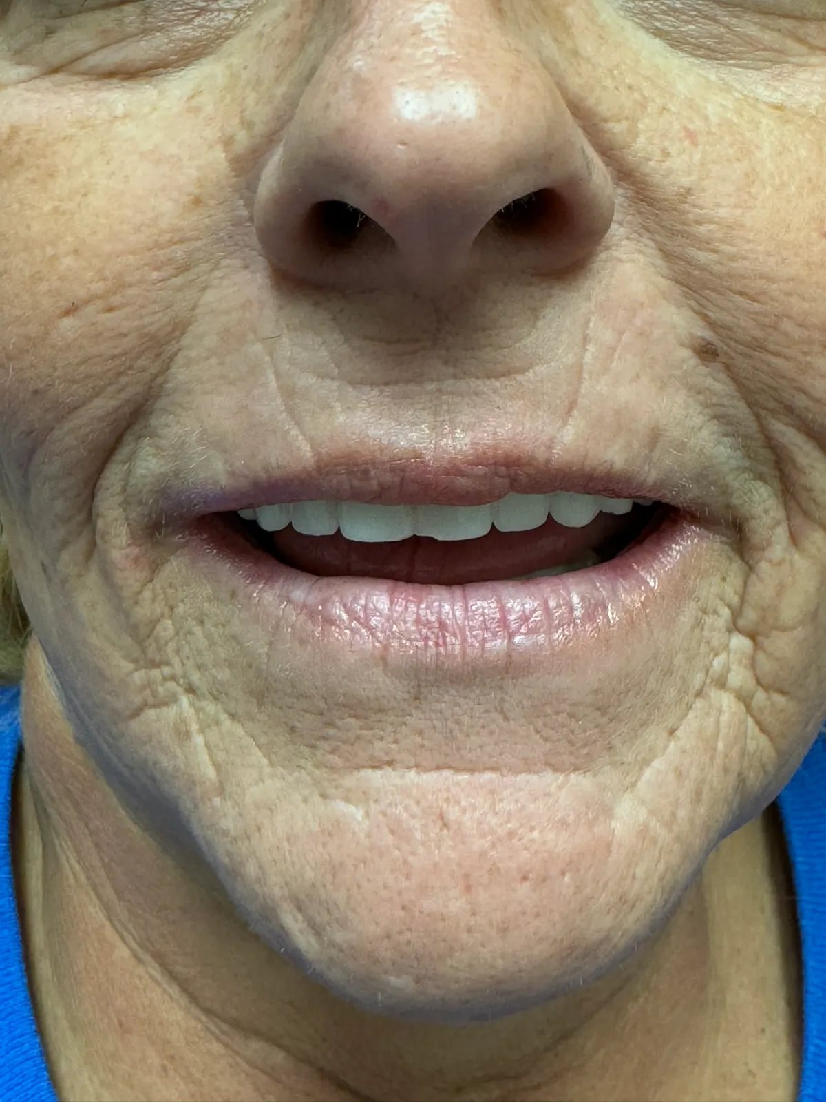 Smile Makeover After Treatment