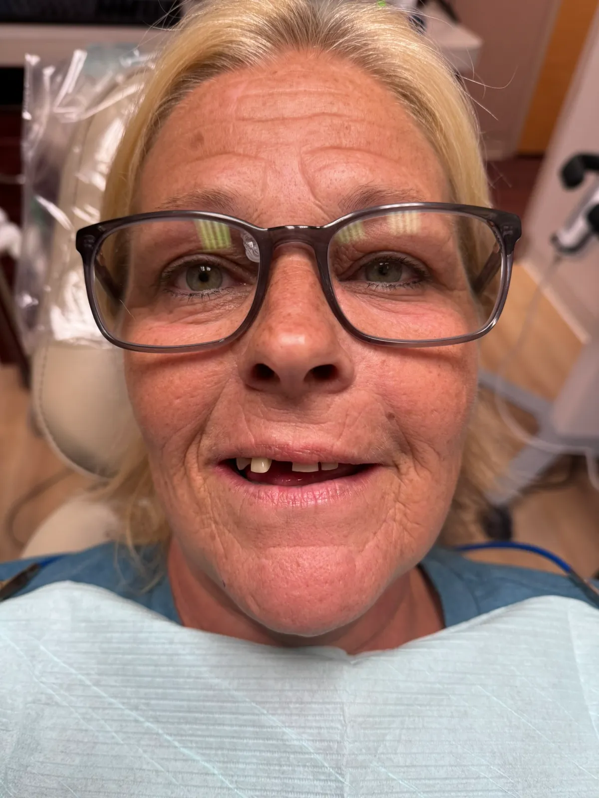 Smile Makeover Before