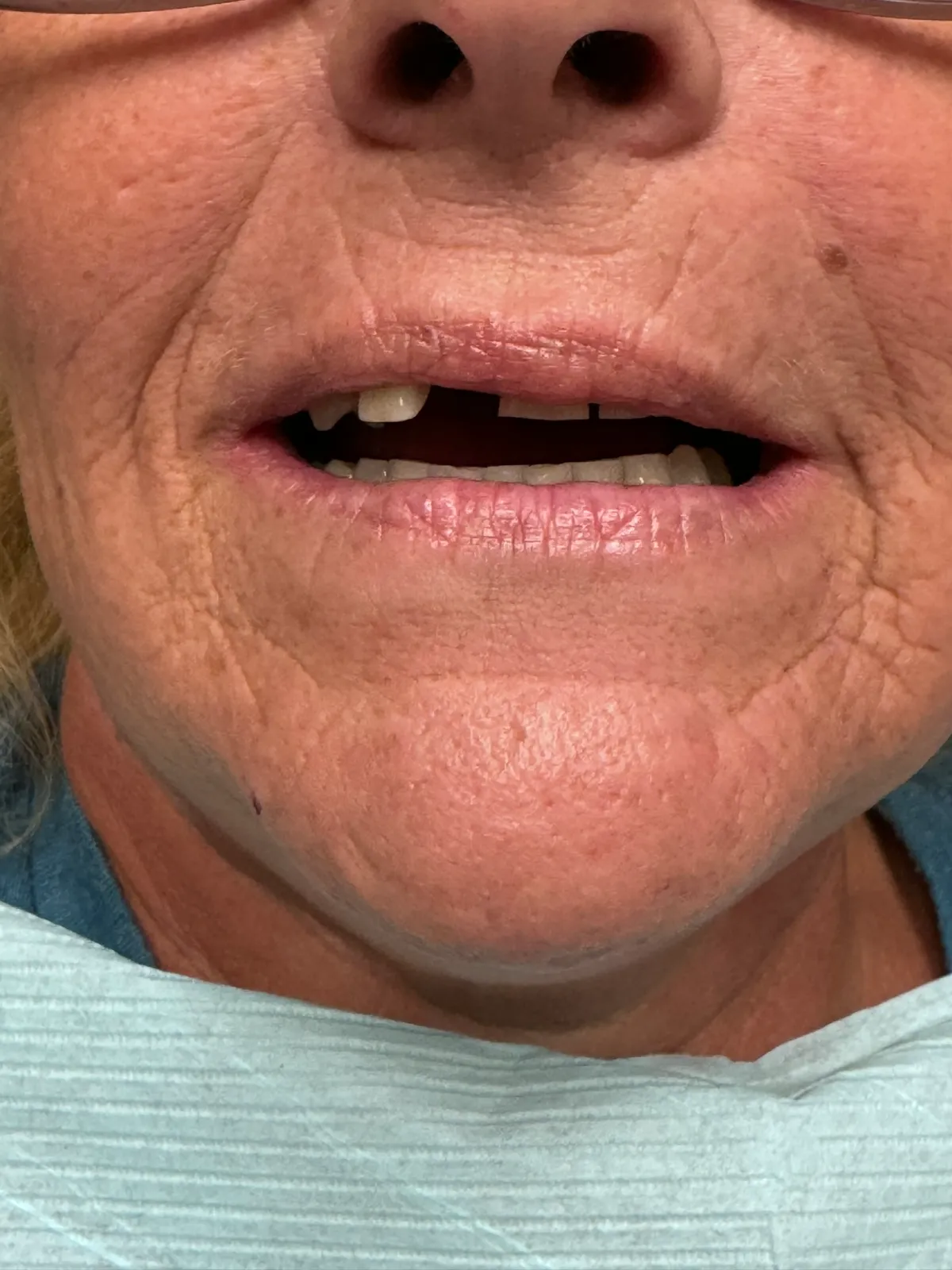 Smile Makeover Before