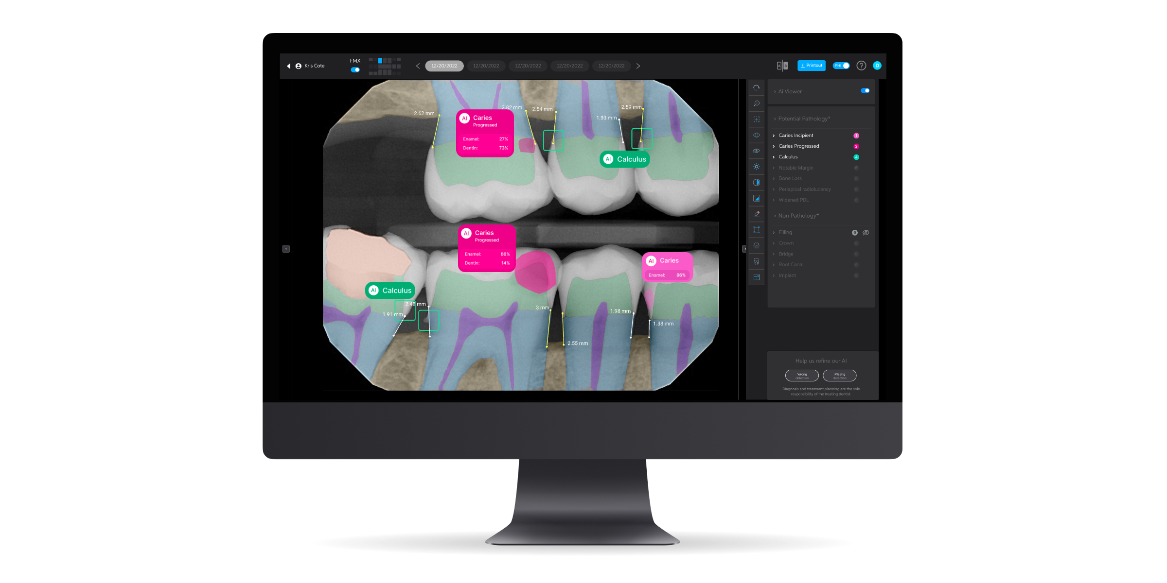 Discover Smarter, Faster Dental Care with Pearl AI at Peak Vision Dental