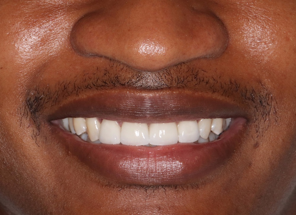 Veneers in East Cobb