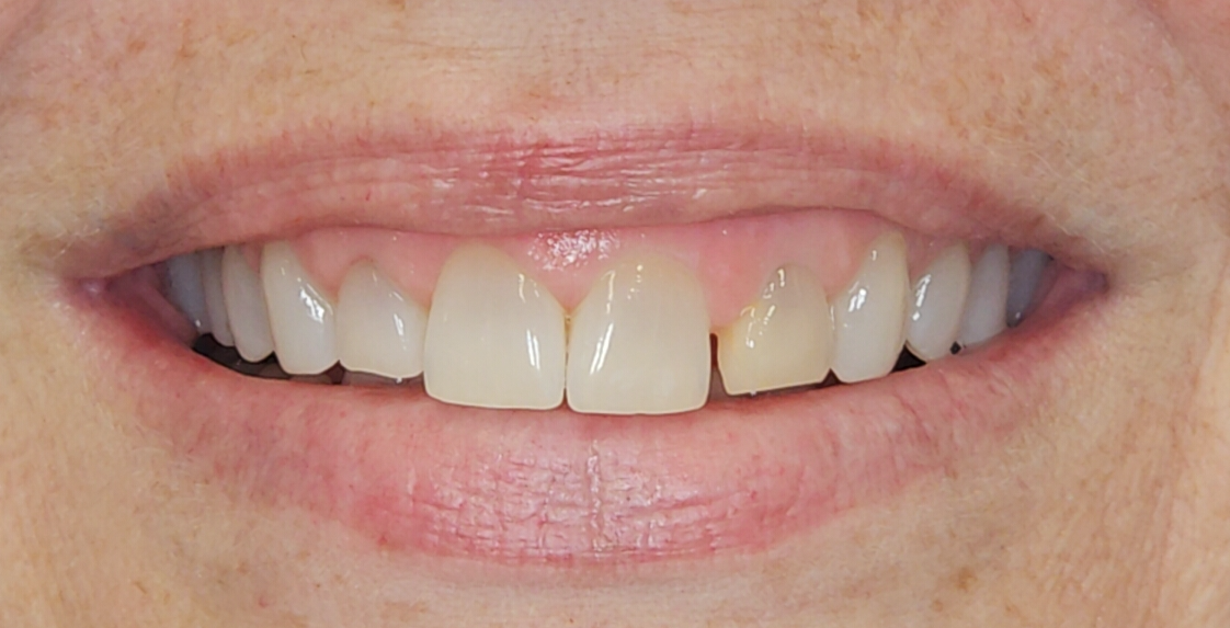 Before Image