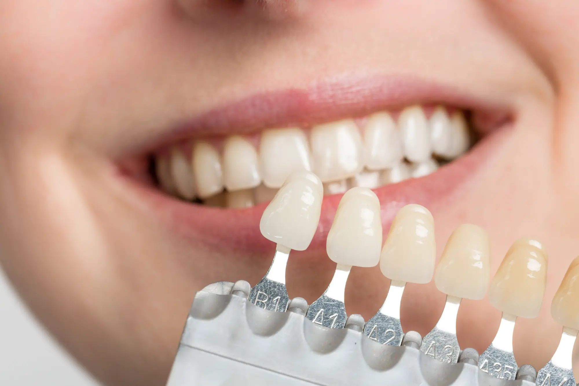 Porcelain Veneers: Your Guide to a Flawless Marietta Smile