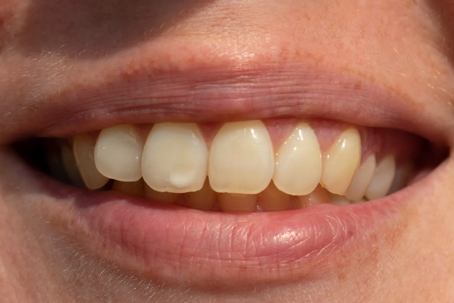 ICON White Spot Removal in Atlanta, GA | Modern Dental Center
