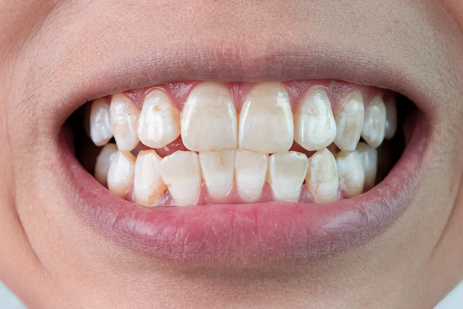 ICON White Spot Removal in Atlanta, GA | Modern Dental Center