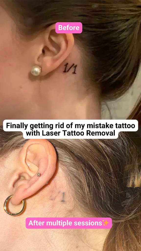 Side-by-side of behind ear tattoo before and after laser removal shows fading of '1/1' ink.