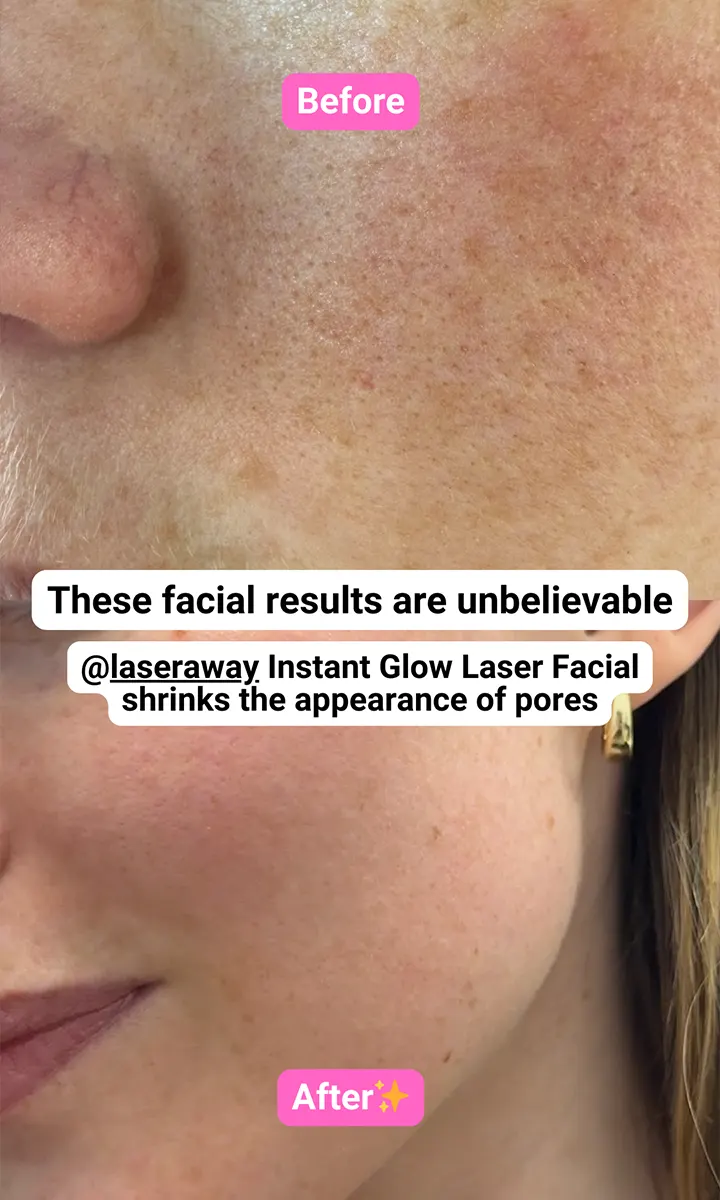 Close-up before and after facial skin showing reduced pore appearance after laser treatment.