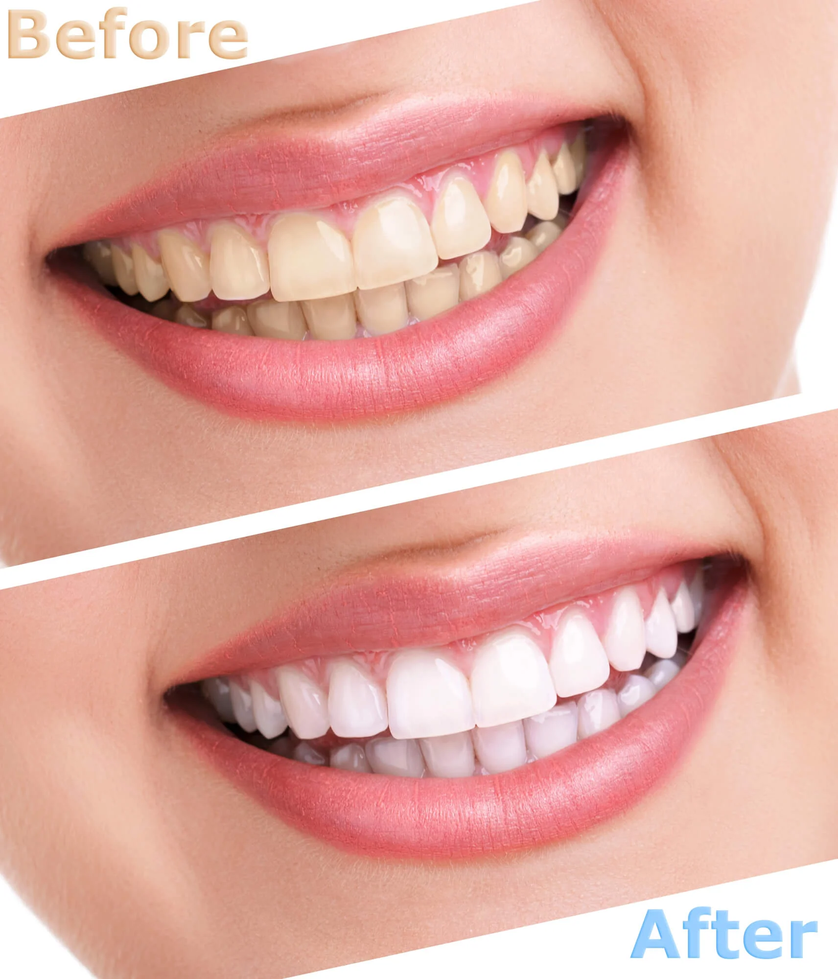 before after smile teeth whitening in Birmingham, AL