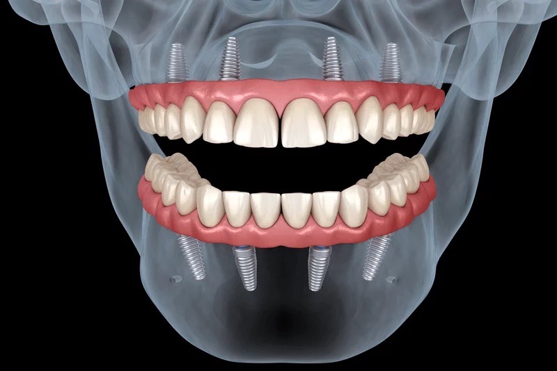 All-on-4 implant, where a full arch of new teeth (either upper or lower) is supported by just four strategically placed dental implants