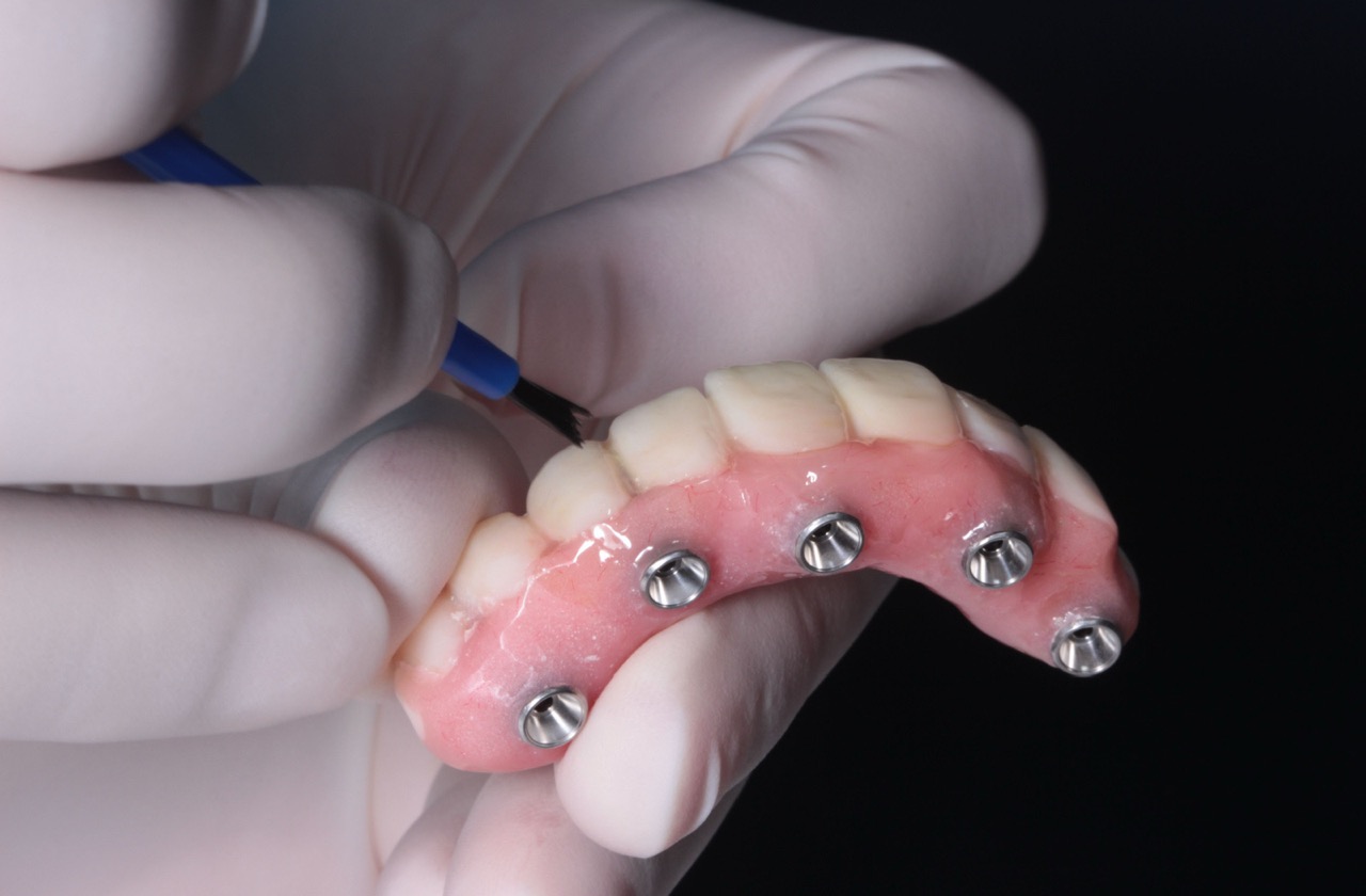 The all on 4 procedure 