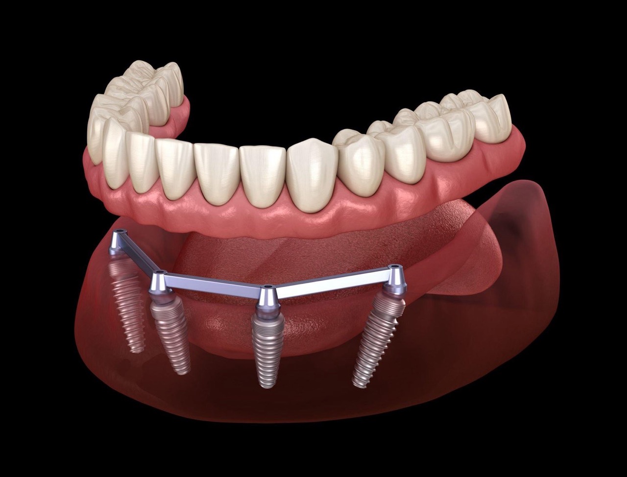 all on 4 dental implants cost