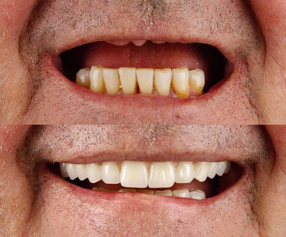 Before and After All-on-four