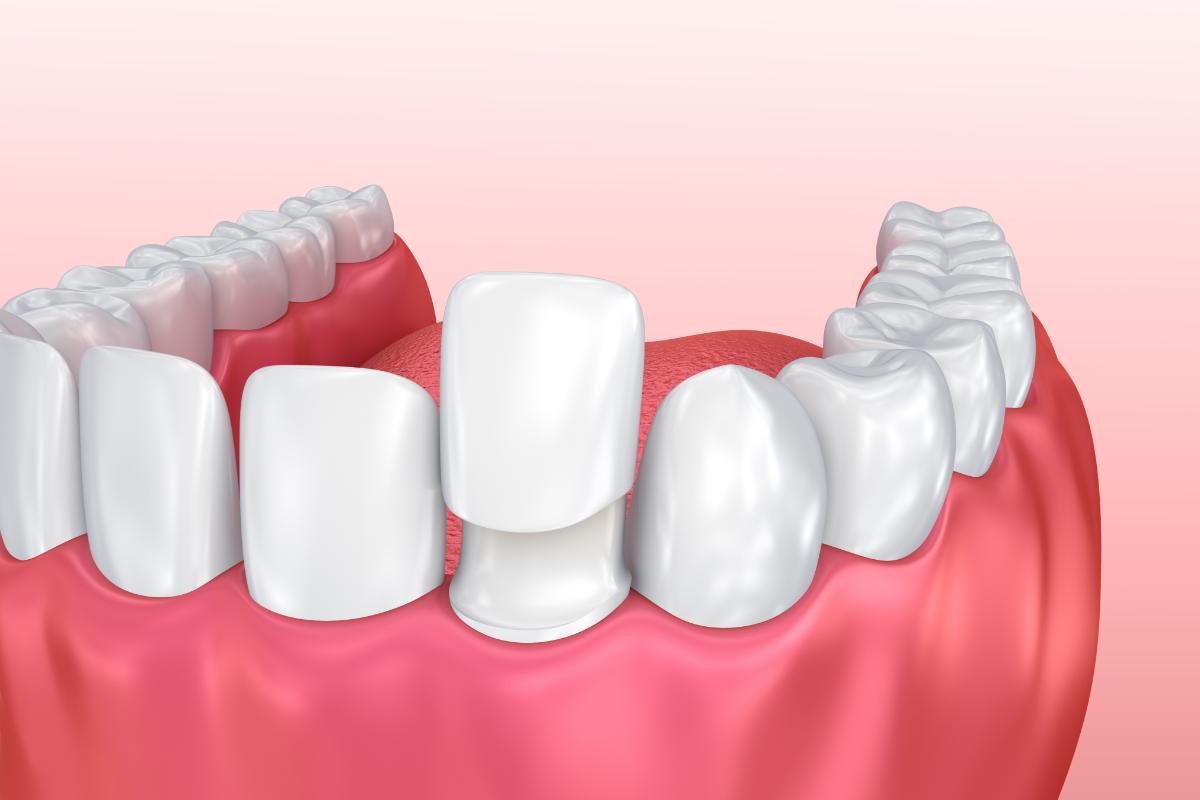 another cartoon image of veneer