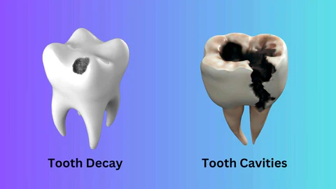 Should care for cavities
