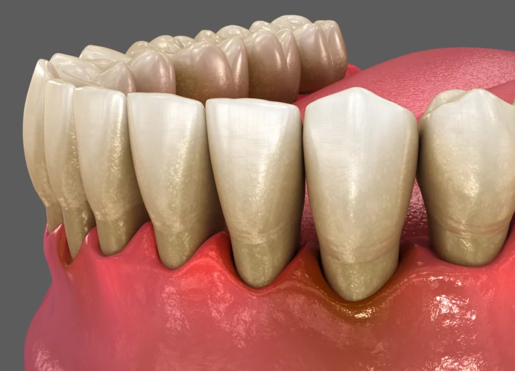 3D prototype of gum recession
