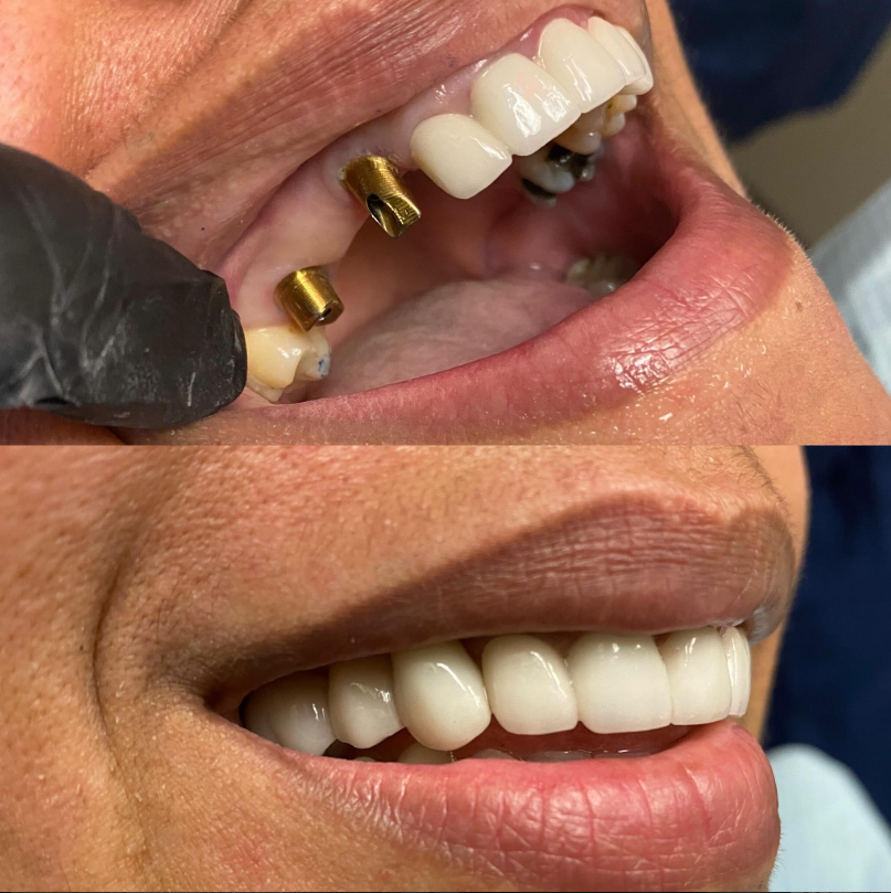 Dental implants near me in Huntersville, NC.