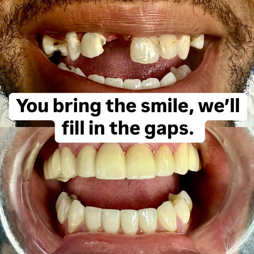 Before-and-after dental implants from our general dentist in Northlake near Charlotte, NC.