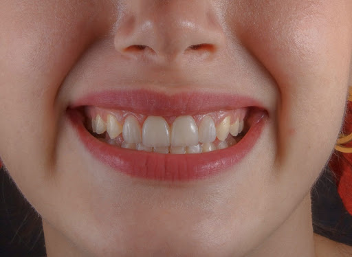 Dentists in Northlake, Charlotte, NC, give gentle gum care for soreness, swelling, or bleeding.