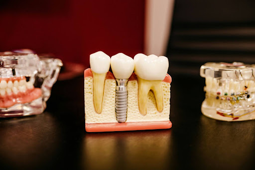 Restore your smile naturally with an implant from dentists in Northlake, Charlotte, NC, that replaces missing teeth with a lasting fit