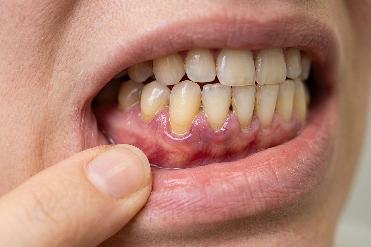 Oral Cancer Screening in Salt Lake City: What Happens During a Routine Screening?