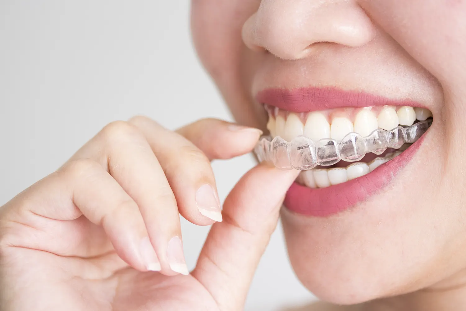 Invisalign in Greensboro | Dr. Layth Saraf