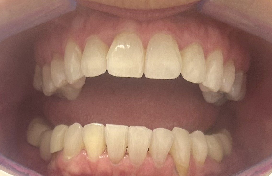 Invisalign