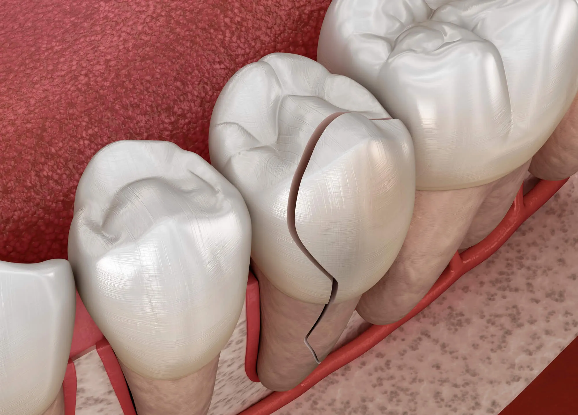 cracked tooth needs to the attention of a walk in dentist greensboro nc